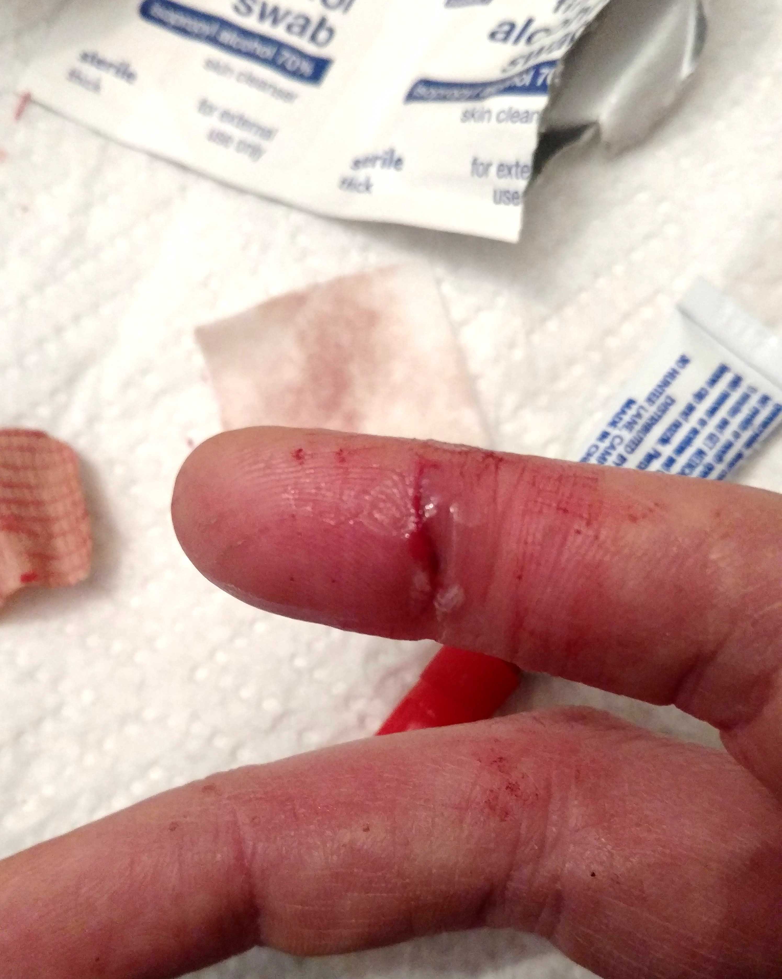 bloody finger patched up with super glue